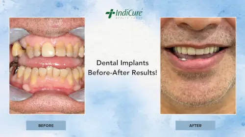 Vincent - Dental Implants Before-After Results Vincent - Dental Implants Before-After Results